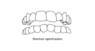 https://odontomedic.com.br/wp-content/uploads/2024/05/Dentes-apinhados.png