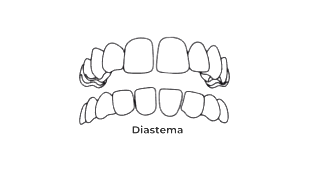 https://odontomedic.com.br/wp-content/uploads/2024/05/Diastema.png