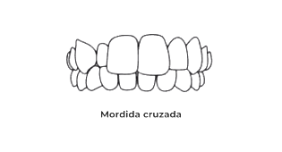 https://odontomedic.com.br/wp-content/uploads/2024/05/Mordida-Cruzada.png