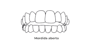 https://odontomedic.com.br/wp-content/uploads/2024/05/Mordida-aberta.png